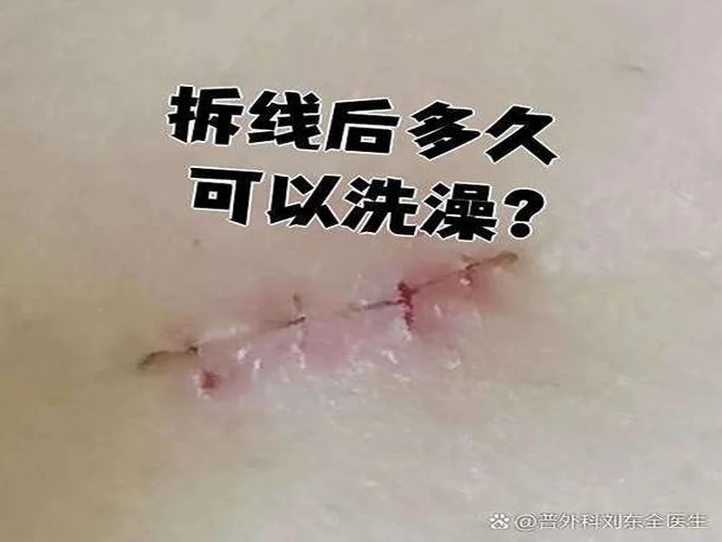 广州豹官方:杨浩眉弓伤口缝合30余针,预计5-7天后拆线